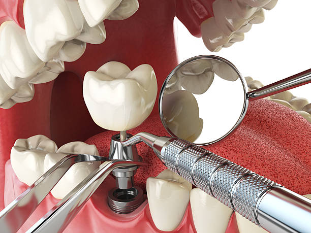 Best Broken or Cracked Tooth Emergency Dentist in Fort Rucker, AL